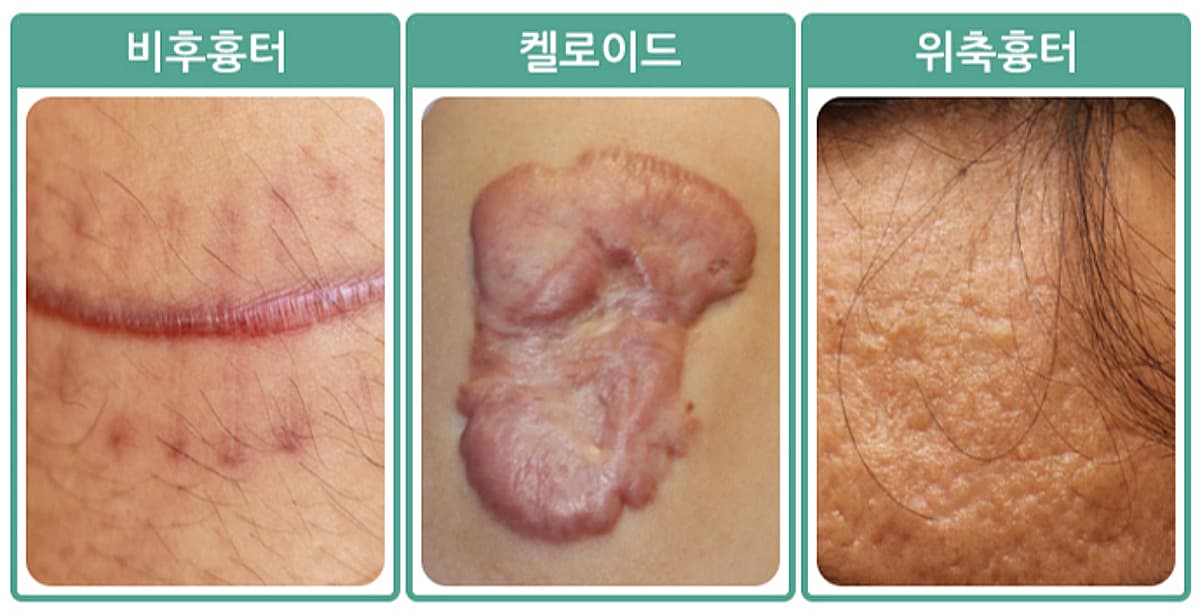 벌레 물림으로 인한 흉터 치료 방법